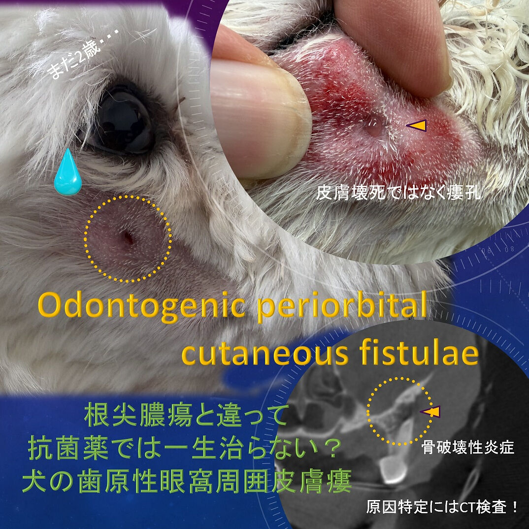 若くても抜歯！Odontogenic Periorbital Cutaneous Fistulae！